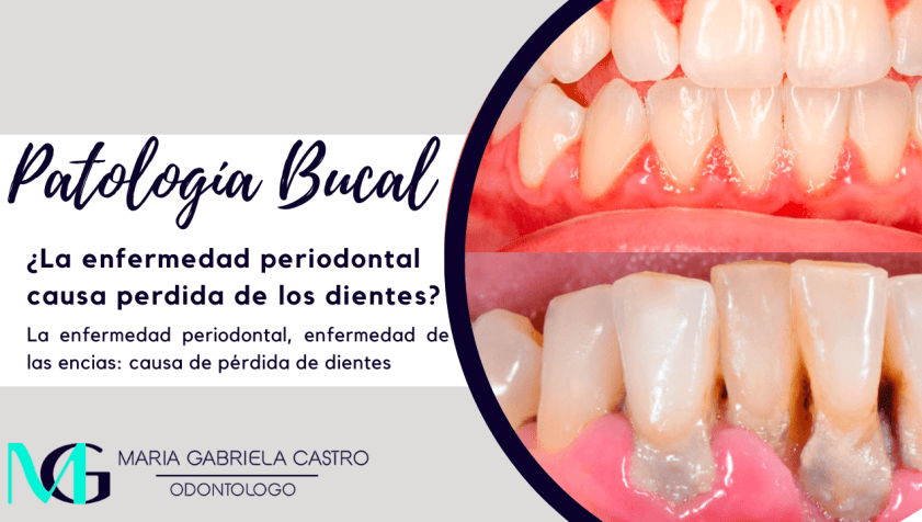 La enfermedad periodontal, enfermedad de las encias: la principal causa de pérdida de dientes