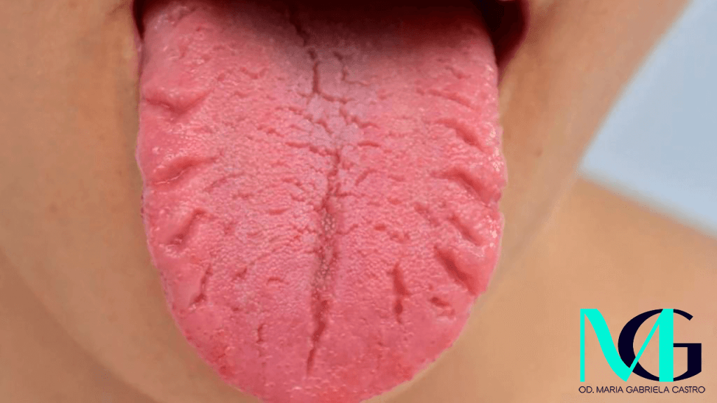 La lengua fisurada o lengua escrotal
