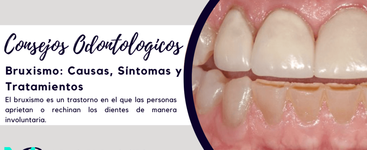 Bruxismo Causas, Síntomas y Tratamientos