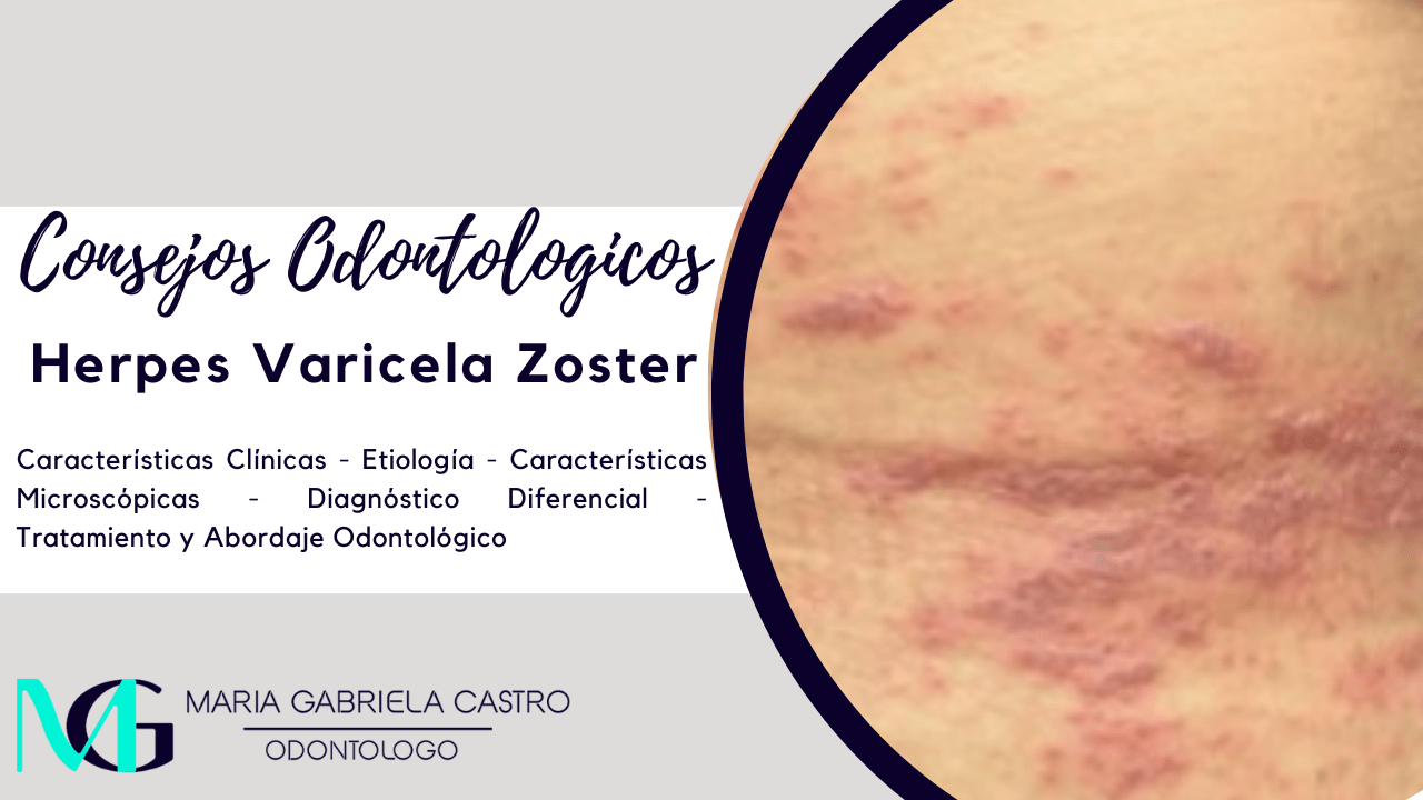 Herpes Varicela Zoster: Características Clínicas, Etiología, Características Microscópicas, Diagnóstico Diferencial, Tratamiento y Abordaje Odontológico.