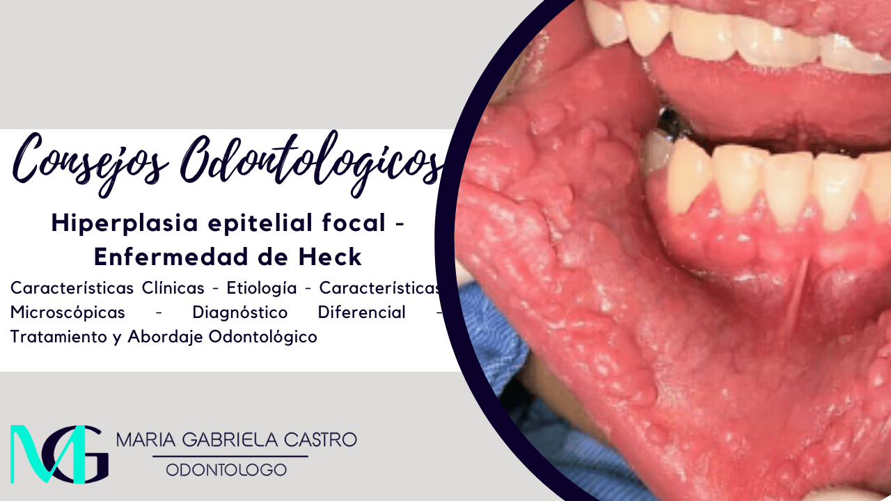 Hiperplasia epitelial focal - Enfermedad de Heck: Características Clínicas, Etiología, Características Microscópicas, Diagnóstico Diferencial, Tratamiento y Abordaje Odontológico