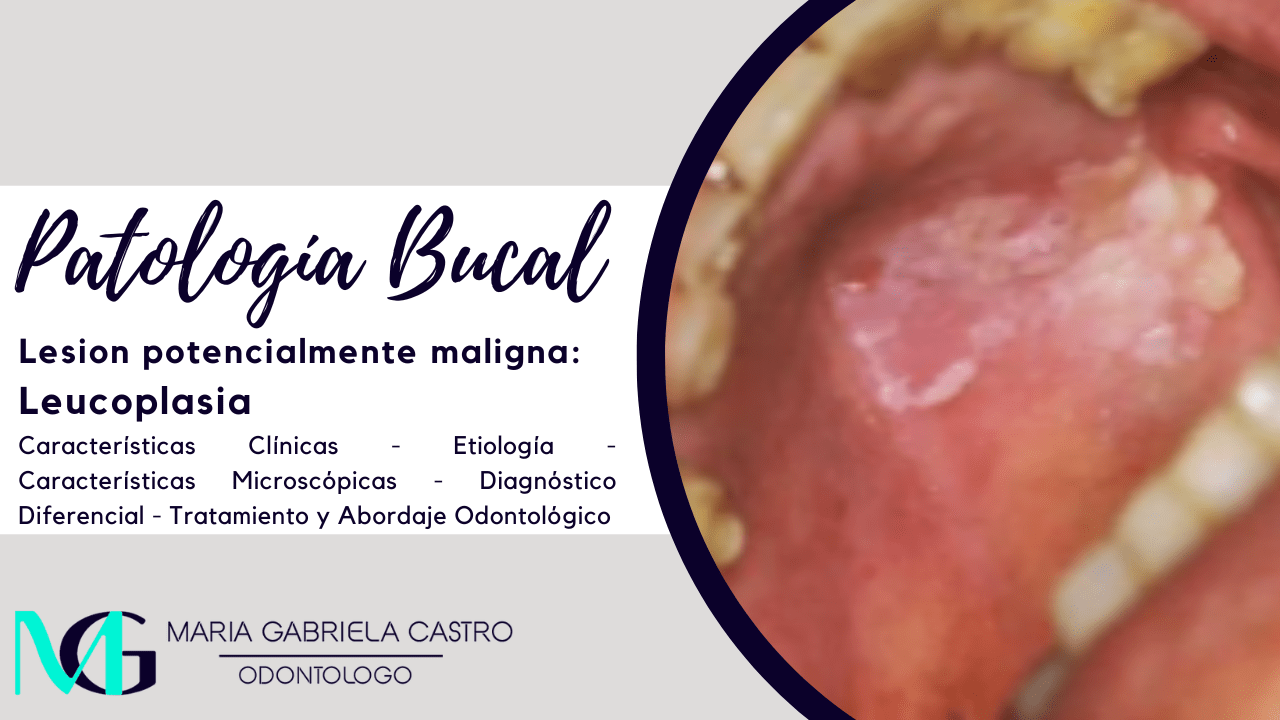 Leucoplasia. Características Clínicas, Etiología, Características Microscópicas, Diagnóstico Diferencial, Tratamiento y Abordaje Odontológico