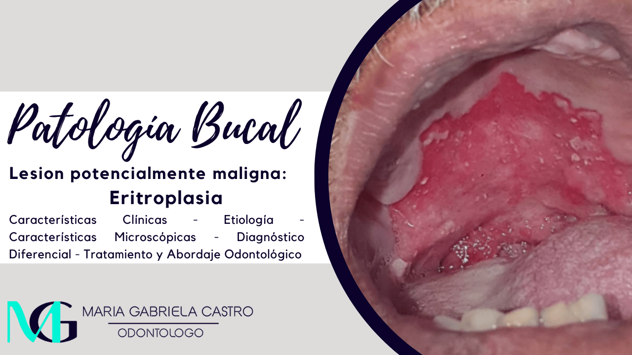 Eritroplasia. Características Clínicas, Etiología, Características Microscópicas, Diagnóstico Diferencial, Tratamiento y Abordaje Odontológico