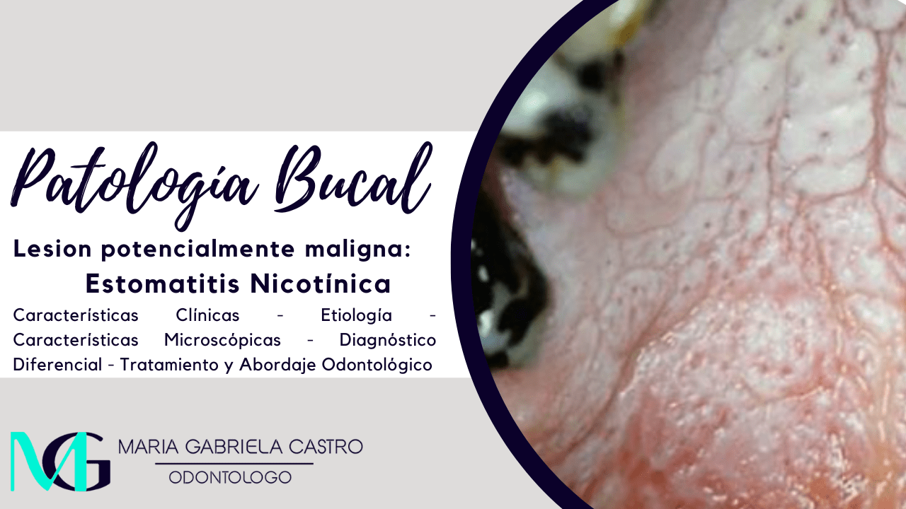 Estomatitis Nicotínica. Características Clínicas, Etiología, Características Microscópicas, Diagnóstico Diferencial, Tratamiento y Abordaje Odontológico