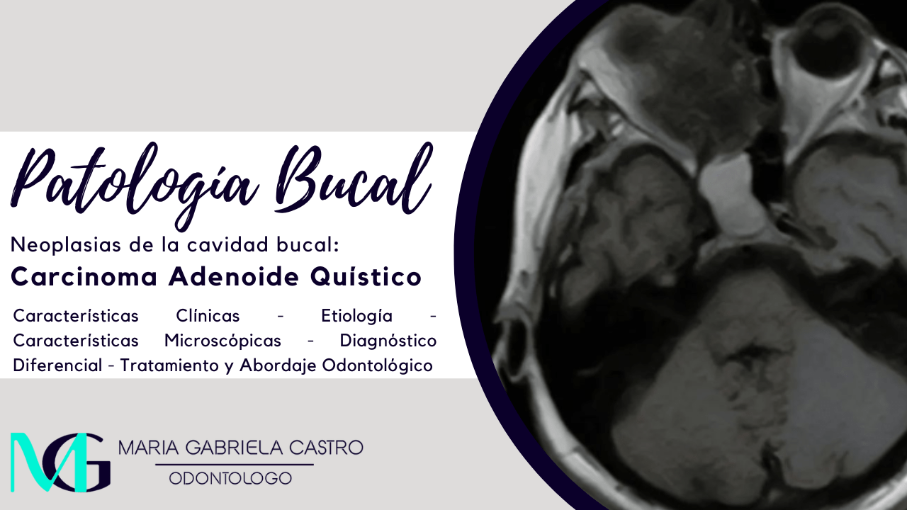 Carcinoma Adenoide Quístico. Características Clínicas, Etiología, Características Microscópicas, Diagnóstico Diferencial, Tratamiento y Abordaje Odontológico