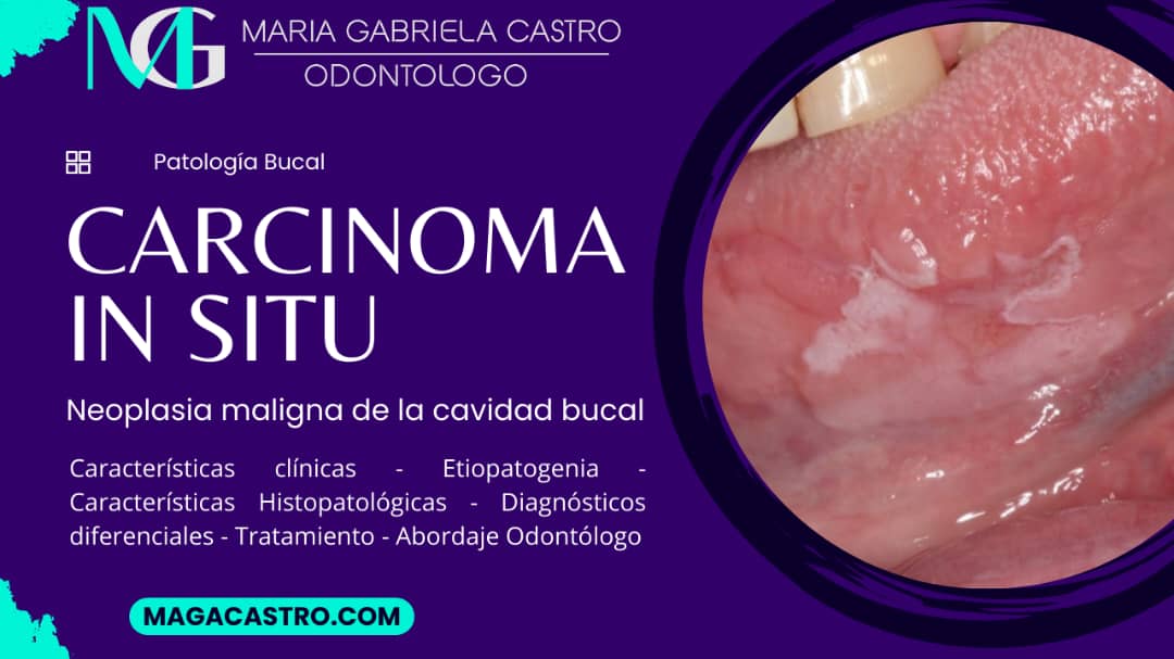 Carcinoma In Situ. Características Clínicas, Etiología, Características Microscópicas, Diagnóstico Diferencial, Tratamiento y Abordaje Odontológico