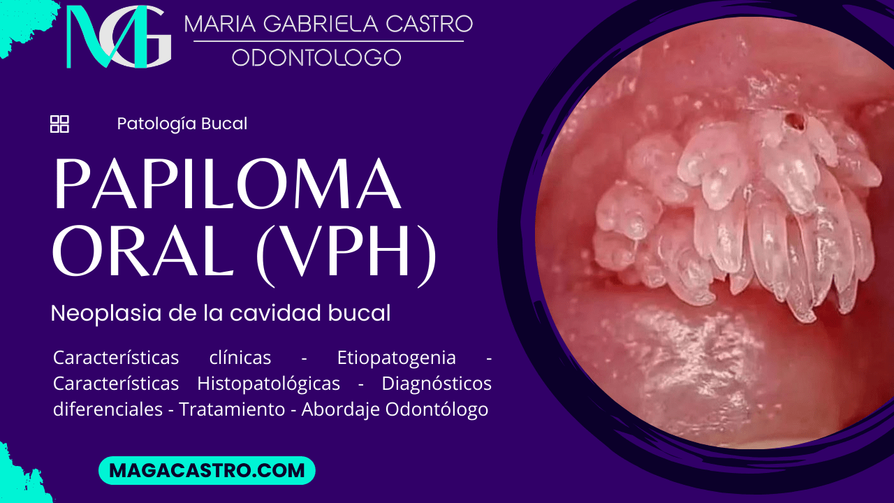 Papiloma. Características Clínicas, Etiología, Características Microscópicas, Diagnóstico Diferencial, Tratamiento y Abordaje Odontológico