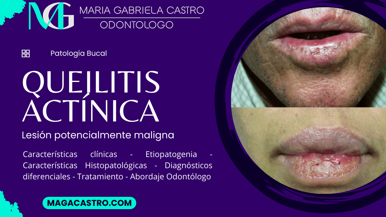 Queilitis Actínica. Características Clínicas, Etiología, Características Microscópicas, Diagnóstico Diferencial, Tratamiento y Abordaje Odontológico