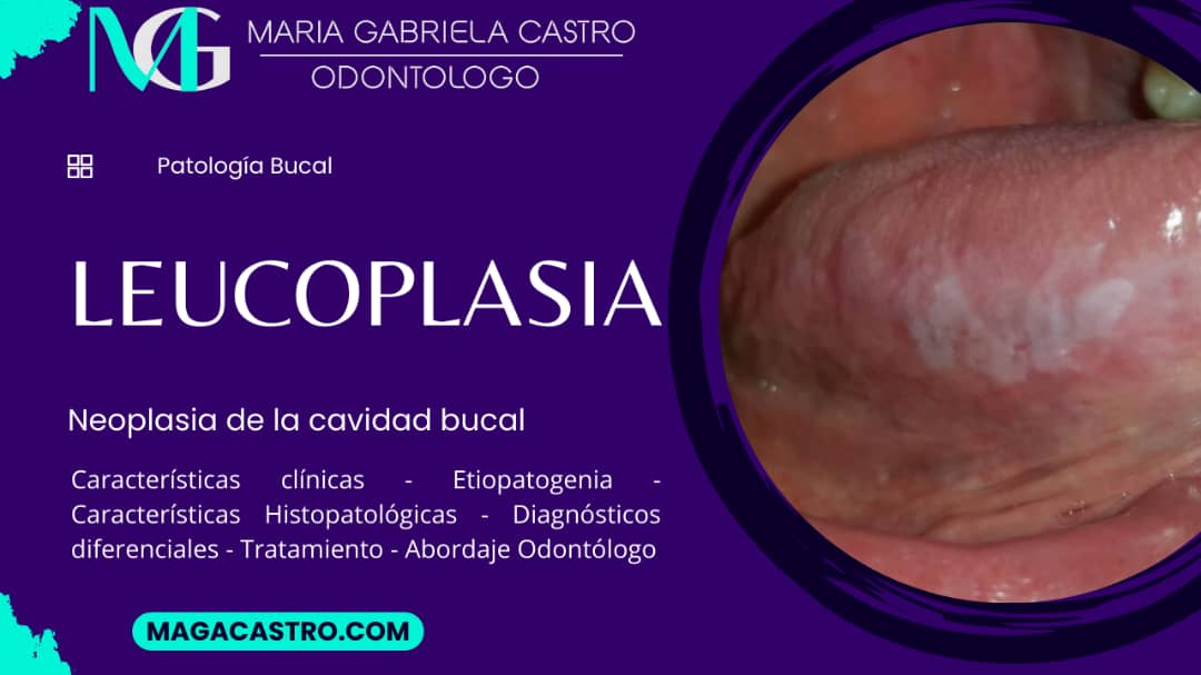 Leucoplasia. Características Clínicas, Etiología, Características Microscópicas, Diagnóstico Diferencial, Tratamiento y Abordaje Odontológico