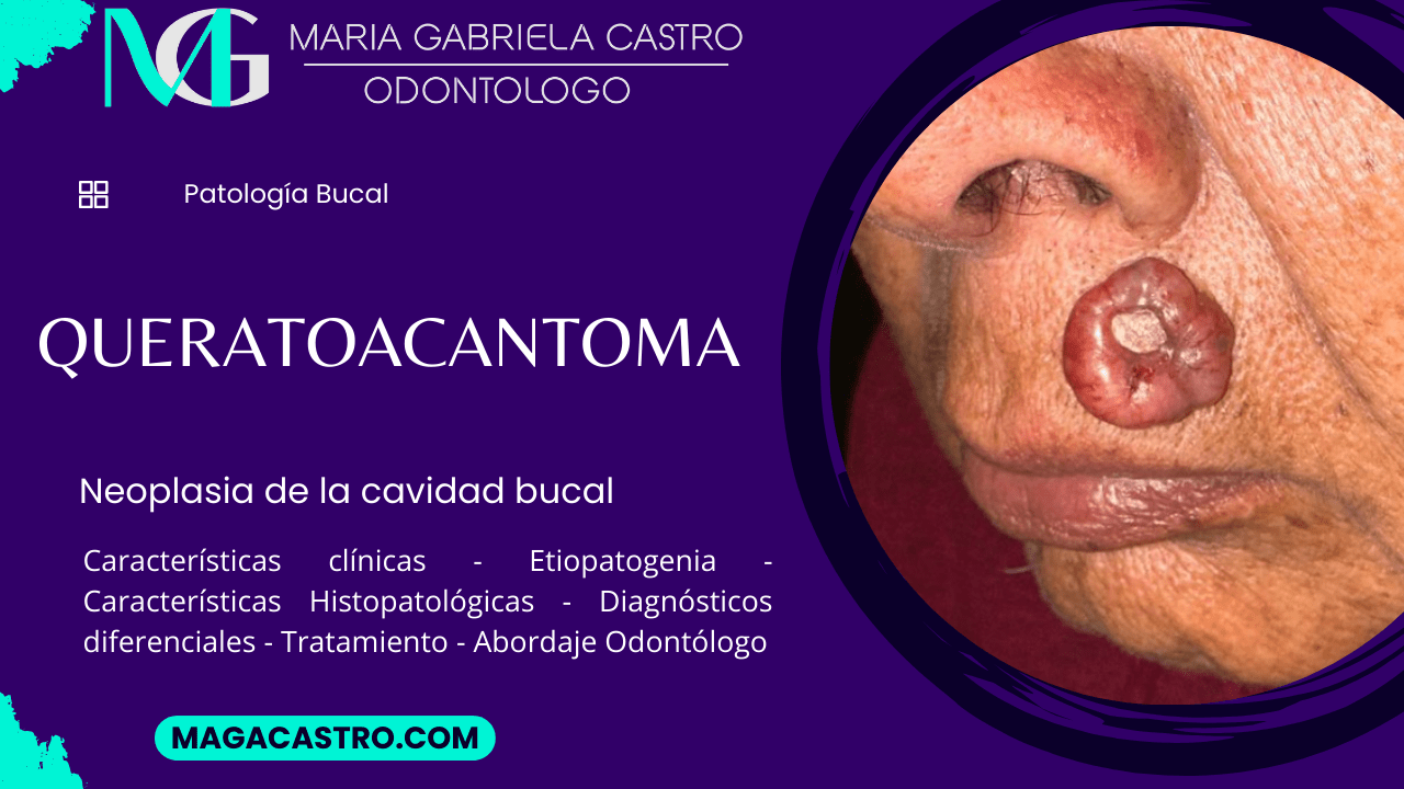 Queratoacantoma. Características Clínicas, Etiología, Características Microscópicas, Diagnóstico Diferencial, Tratamiento y Abordaje Odontológico