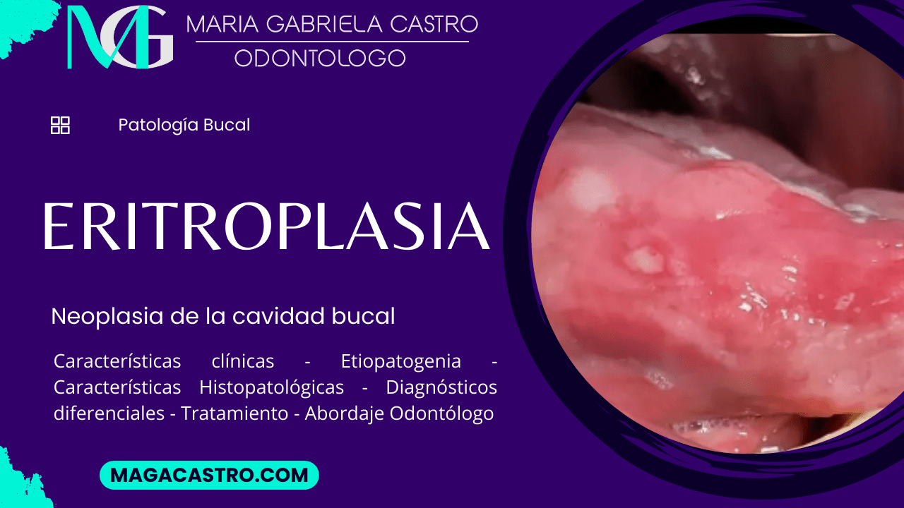 Eritroplasia. Características Clínicas, Etiología, Características Microscópicas, Diagnóstico Diferencial, Tratamiento y Abordaje Odontológico