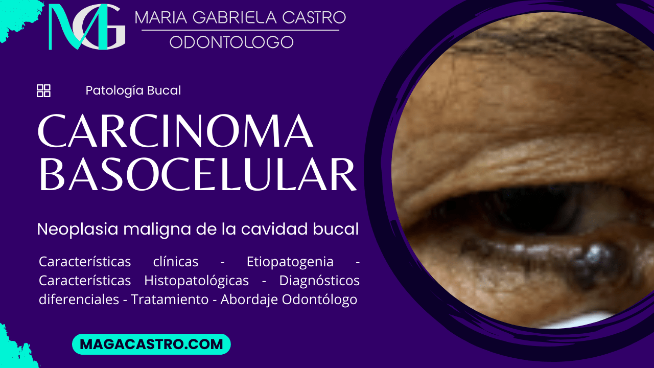 Carcinoma Basocelular. Características Clínicas, Etiología, Características Microscópicas, Diagnóstico Diferencial, Tratamiento y Abordaje Odontológico