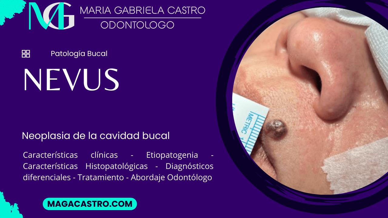 Nevus. Características Clínicas, Etiología, Características Microscópicas, Diagnóstico Diferencial, Tratamiento y Abordaje Odontológico