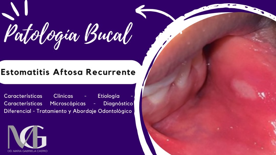 Estomatitis Aftosa Recurrente Características Clínicas, Etiología, Características Microscópicas, Diagnóstico Diferencial, Tratamiento y Abordaje Odontológico